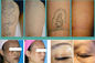 Rimozione professionale 1064nm/attrezzature Q-commutate 532nm del tatuaggio del laser del ND YAG